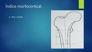 Índice morfocortical
IMC= CD/AD