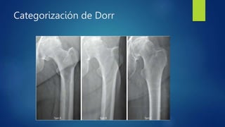 Categorización de Dorr