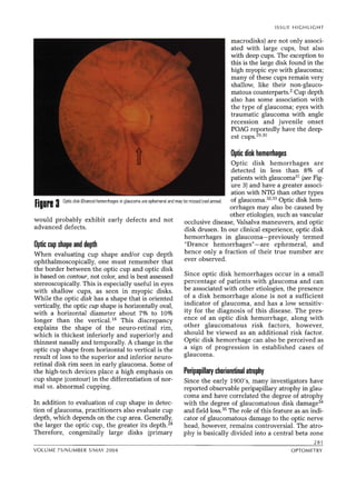 Criterios diagnosticos en glaucoma | PDF