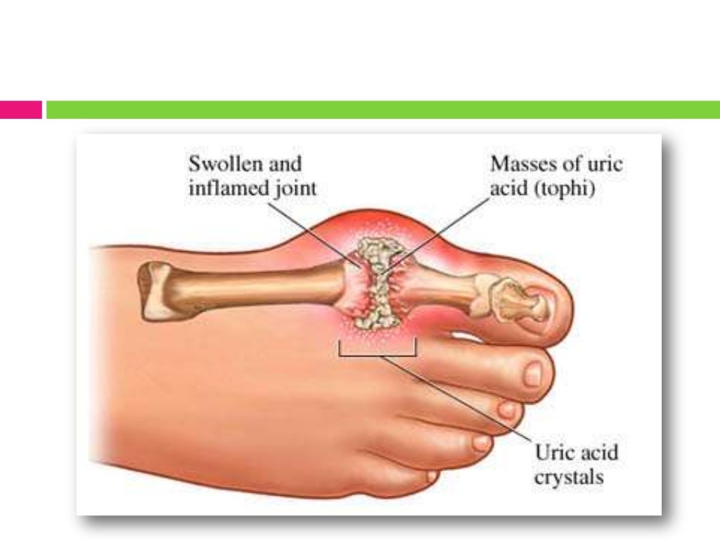 Criterios diagnosticos para artritis gotosa