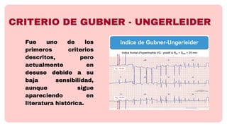 Gubner criterios electrocardiograficos para HVI- Brenda Simpertegui.pdf