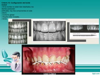 Criterio 12: Configuración del borde
incisal
¦ Si los bordes no están bien diseñados, los
dientes parecerán
artificiales. hay tres componentes en este
criterio:
¦ Contorno global
¦ Ángulos Inter incisales.
¦ Groso
 