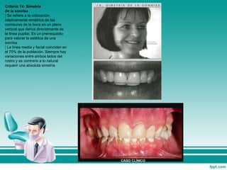 Criterio 14: Simetría
de la sonrisa
¦ Se refiere a la colocación,
relativamente simétrica de las
comisuras de la boca en un plano
vertical que deriva directamente de
la línea pupilar. Es un prerrequisito
para valorar la estética de una
sonrisa.
¦ La línea media y facial coinciden en
el 70% de la población. Siempre hay
variaciones entre ambos lados del
rostro y es contrario a lo natural
requerir una absoluta simetría
 