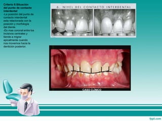 Criterio 6:Situación
del punto de contacto
interdental
-La posición del punto de
contacto interdental
esta relacionada con la
posición y morfología
del diente.
-Es mas coronal entre los
incisivos centrales y
tiende a migrar
apicalmente cuando
nos movemos hacia la
dentición posterior.
 