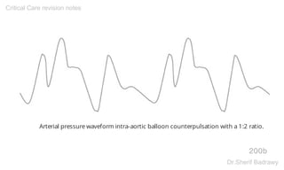 Arterial pressure waveform intra-aortic balloon counterpulsation with a 1:2 ratio.
200b
Critical Care revision notes
Dr.Sherif Badrawy
 