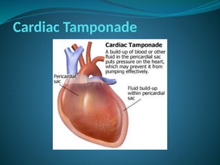 Cardiac Tamponade
 