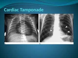 Cardiac Tamponade
 