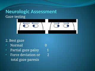 Neurologic Assessment
Gaze testing
2. Best gaze
• Normal 0
• Partial gaze palsy 1
• Force deviation or 2
total gaze paresis
 