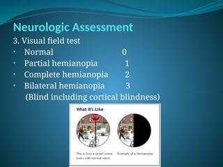 Neurologic Assessment
3. Visual field test
• Normal 0
• Partial hemianopia 1
• Complete hemianopia 2
• Bilateral hemianopia 3
(Blind including cortical blindness)
 
