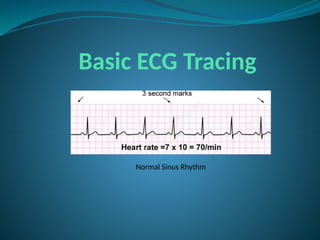 Basic ECG Tracing
Normal Sinus Rhythm
 