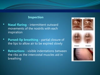 Inspection
 Nasal flaring - intermittent outward
movements of the nostrils with each
inspiration
 Pursed-lip breathing - partial closure of
the lips to allow air to be expired slowly
 Retractions - visible indentations between
the ribs as the intercostal muscles aid in
breathing
 