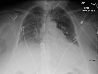 Systolic anterior motion of mitral valve - SAM | PPT