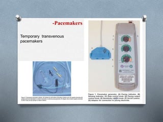 -Pacemakers 
Temporary transvenous 
pacemakers 
17 
 
