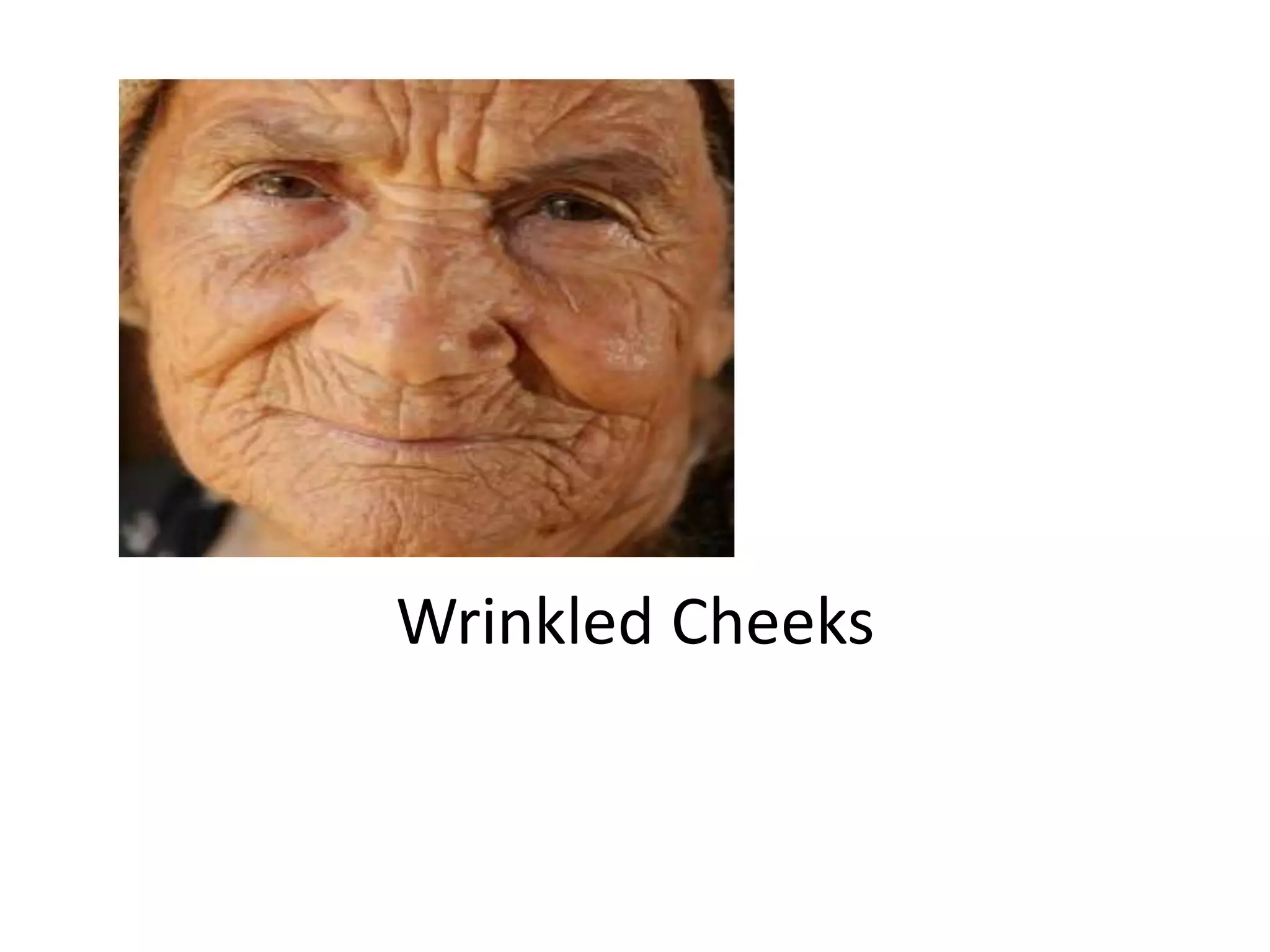 Wrinkled Cheeks
 