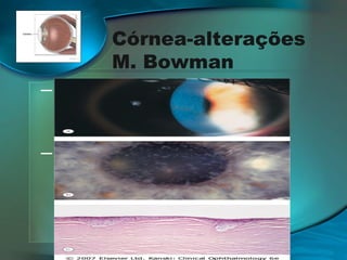Córnea-alterações
M. Bowman
─ Distrofia Corneana de Bowman1
(CDB1)/Dist. Reis-Bückler
─ Distrofia Corneana de Bowman 2
(CDB2)/Dist. Thiel-Behnke

 