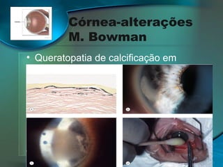 Córnea-alterações
M. Bowman
• Queratopatia de calcificação em
banda:

 