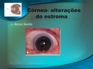 Córnea- alterações
do estroma
─ Arcus Senilis

 