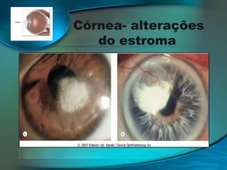 Córnea- alterações
do estroma
─ Queratopatia lipídica;
─ Córnea farinata;
─ Distrofia de Latice tipo 1, 2, 3 e 3A;
─ Distrofia Granular Tipo 1 e 2;
─ Distrofia Macular;
─ Distrofia Gelatinosa;
─ Distrofia Central de François;

 