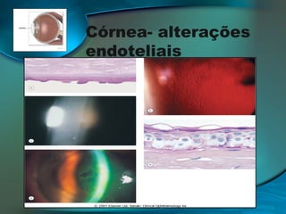 Córnea- alterações
endoteliais
• Queratopatia Bolhosa;
• Distrofia Endotelial de Fuchs;
• Distrofia Polimorfa Posterior;
• Distrofia Endotelial hereditária Congénita;

 