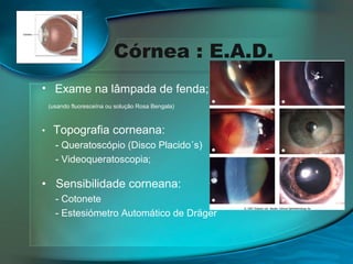 Córnea : E.A.D.
• Exame na lâmpada de fenda;
(usando fluoresceína ou solução Rosa Bengala)

•

Topografia corneana:
- Queratoscópio (Disco Placido´s)
- Videoqueratoscopia;

• Sensibilidade corneana:
- Cotonete
- Estesiómetro Automático de Dräger

 