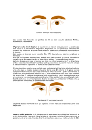 Parálisis del III par craneal derecho 
Las causas más frecuentes de parálisis del III par son vasculitis (Diabetes Mellitus, 
Hipertensión) y aneurismas. 
IV par craneal o Nervio troclear. El IV par inerva el músculo oblicuo superior. La parálisis de 
este nervio es la mas difícil de diagnosticar. El paciente con una parálisis de este nervio se 
presenta con hipertropia e inclinación de la cabeza para el lado contralateral para compensar 
la diplopía. 
Las causas so diversas como vasculitis DM, HTA, traumatismos, lesiones congénitas o 
tumorales. 
El IV par se origina en el mesencéfalo, emerge en la parte posterior y rodea el tallo cerebral 
dirigiéndose al seno cavernoso. Es un nervio largo, delgado y muy susceptible a lesiones. 
La lesión de este par craneal no permite que el ojo vea inferior y nasalmente. Y se dirige hacia 
arriba y presenta una ciclotorsión rotando al ojo lo que condiciona al paciente inclinar la cabeza 
al lado contralateral. Al paciente se le dificulta leer y bajar escaleras. 
El músculo oblicuo superior corre desde la parte posterior de la órbita hacia delante a través de 
una polea que se localiza cercano al puente de la nariz. El sistema de la polea cambia 
completamente la dirección de fuerza del músculo oblicuo superior. ( podría considerarse la 
polea como el origen funcional del músculo). El músculo se inserta arriba de la parte posterior 
del globo ocular y tracciona abruptamente el ojo en movimiento inferior. Adicionalmente tiene 
un movimiento intorsional que rota la posición a las 12 del reloj del limbo corneal hacia la naríz. 
Cuando se lesiona el nervio el paciente, durante la exploración, al tratar de ver hacia arriba y 
afuera del lado contralateral, el ojo se desplaza hacia arriba. 
Parálisis del IV par craneal derecho 
La pérdida de este movimiento es lo que explica la posición inclinada del paciente cuando este 
se paraliza. 
VI par o Nervio abducens. El VI par se origina en la parte baja del puente y sale del tallo en la 
unión pontomedular y asciende hacia la base de cráneo para dirigirse al seno cavernoso y 
posteriormente a la órbita. Cuando el nervio entra al seno cavernoso realiza un giro de 90º, 
 