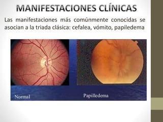 Las manifestaciones más comúnmente conocidas se
asocian a la triada clásica: cefalea, vómito, papiledema
 