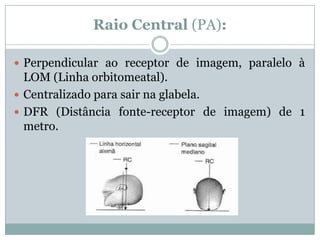 Raio Central (PA):
 Perpendicular ao receptor de imagem, paralelo à
LOM (Linha orbitomeatal).
 Centralizado para sair na glabela.
 DFR (Distância fonte-receptor de imagem) de 1
metro.
 