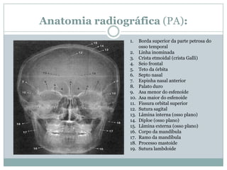 Anatomia radiográfica (PA):
1. Borda superior da parte petrosa do
osso temporal
2. Linha inominada
3. Crista etmoidal (crista Galli)
4. Seio frontal
5. Teto da órbita
6. Septo nasal
7. Espinha nasal anterior
8. Palato duro
9. Asa menor do esfenoide
10. Asa maior do esfenoide
11. Fissura orbital superior
12. Sutura sagital
13. Lâmina interna (osso plano)
14. Díploe (osso plano)
15. Lâmina externa (osso plano)
16. Corpo da mandíbula
17. Ramo da mandíbula
18. Processo mastoide
19. Sutura lambdoide
 
