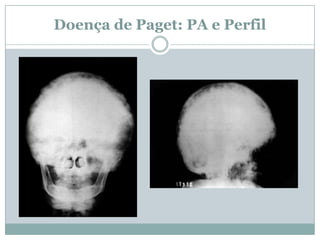 Doença de Paget: PA e Perfil
 