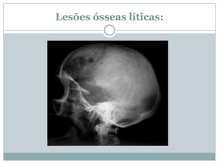 Lesões ósseas líticas:
 
