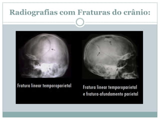 Radiografias com Fraturas do crânio:
 
