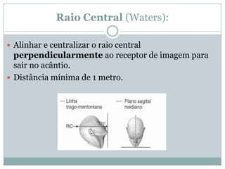 Raio Central (Waters):
 Alinhar e centralizar o raio central
perpendicularmente ao receptor de imagem para
sair no acântio.
 Distância mínima de 1 metro.
 