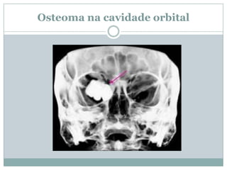 Osteoma na cavidade orbital
 