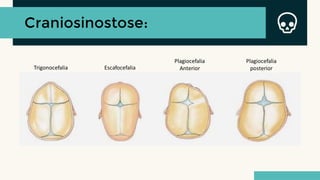 Craniosinostose:
Escafocefalia
Trigonocefalia
Plagiocefalia
Anterior
Plagiocefalia
posterior
 