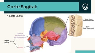 Corte Sagital:
• Corte Sagital
Lâmina
perpendicular
do osso Etmoide
Vômer
Septo
Nasal
 