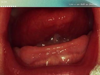 SCM
                                                         Leve o seu Bebê ao Dentista

   EXAME CLÍNICO DO BEBÊ-ANDO-1973/SILMAN-1973

EXAME INTRA ORAL-          ROLETE GENGIVAL RECOBERTOS
POR TECIDO GENGIVAL. ABAULAMENTO S QUE REPRESENTAM OS
GERMES DOS DENTES DECÍDUOS.
MAXILA AO NASCIMENTO-ROLETE SUPERIOR, FORMATO DE
ARREDONDADO E PALATO POUCO PROFUNDO.
ROLETE DE ROBIM*
SULCOS LATERAIS
BRIDAS LATERAIS
FREIO LABIAL SUPERIOR
RAFE PALATINA
RUGOSIDADES PALATINAS
PAPILA INCISIVA
MANDIBULA-ROLETE INFERIOR FORMA DE “U”.
INCLINADA PARA VESTIBULAR.
ROLETE DE ROBIM- BIZELADO NO SENTIDO VESTBULO LINGUAL*
FREIO LABIAL INFERIOR
BRIDAS
SULCOS LATERAIS
ASSOALHO LINGUAL
FREIO LINGUAL
*HAUP-1958 –AUXILIA NO VEDAMENTO
ANTERIOR DURANTE A SUCÇÃO
 