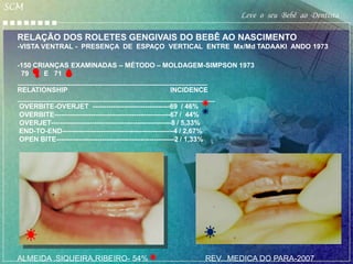 SCM
                                                                    Leve o seu Bebê ao Dentista

  RELAÇÃO DOS ROLETES GENGIVAIS DO BEBÊ AO NASCIMENTO
  -VISTA VENTRAL - PRESENÇA DE ESPAÇO VERTICAL ENTRE Mx/Md TADAAKI ANDO 1973

  -150 CRIANÇAS EXAMINADAS – MÉTODO – MOLDAGEM-SIMPSON 1973
   79     E 71
  __________________________________________________
  RELATIONSHIP                                                 INCIDENCE
  ____________________________________________________
   OVERBITE-OVERJET ----------------------------------69 / 46%
   OVERBITE---------------------------------------------------67 / 44%
   OVERJET-----------------------------------------------------8 / 5,33%
   END-TO-END-------------------------------------------------4 / 2,67%
   OPEN BITE----------------------------------------------------2 / 1,33%




  ALMEIDA ,SIQUEIRA,RIBEIRO- 54%                          REV...MEDICA DO PARA-2007
 