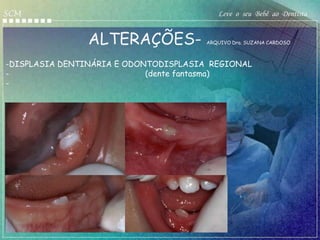 SCM                                       Leve o seu Bebê ao Dentista


                     ALTERAÇÕES-       ARQUIVO Dra. SUZANA CARDOSO



-DISPLASIA DENTINÁRIA E ODONTODISPLASIA REGIONAL
-                           (dente fantasma)
-




      Anne Gueddes
 