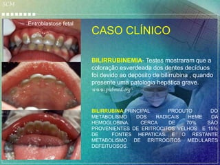 SCM


      Eritroblastose fetal
                             CASO CLÍNICO

                             BILIRRUBINEMIA- Testes mostraram que a
                             coloração esverdeada dos dentes decíduos
                             foi devido ao depósito de bilirrubina , quando
                             presente uma patologia hepática grave.
                             www.pubmed.org


                             BILIRRUBINA:PRINCIPAL     PRODUTO     DO
                             METABOLISMO     DOS   RADICAIS  HEME  DA
                             HEMOGLOBINA.      CERCA   DE   70%   SÃO
                             PROVENIENTES DE ERITROCITOS VELHOS E 15%
                             DE     FONTES HEPATICAS E O RESTANTE
                             METABOLISMO DE ERITROCITOS MEDULARES
                             DEFEITUOSOS.
 