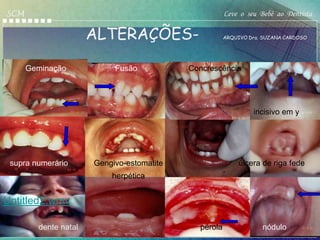 SCM                                                   Leve o seu Bebê ao Dentista

                      ALTERAÇÕES-                     ARQUIVO Dra. SUZANA CARDOSO




      Geminação            Fusão           Concrescência




                                                               incisivo em y




 supra numerário      Gengivo-estomatite                   úlcera de riga fede
                          herpética


Untitled2.wmv

        dente natal                          pérola               nódulo
 