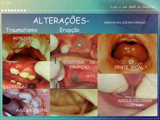SCM
                                                  Leve o seu Bebê ao Dentista


               ALTERAÇÕES-                    ARQUIVO Dra. SUZANA CARDOSO


 Traumatismo                    Erupção
      INTRUSÃO




                                HEMATOMA DE
                                   ERUPÇÃO           DENTE NATAL



 COMOÇÃO


                                                       ANQUILIGLOSSIA

       AVULSÃO TOTAL
         Dr Josef Bruner-1999
 