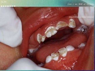 SCM
                                                Leve o seu Bebê ao Dentista


         CÁRIE DENTÁRIA
         transmissibilidade                      ARQUIVO Dra. SUZANA CARDOSO




      Mancha Branca           Lesões de Cárie




             Cárie da Primeira Infância
 