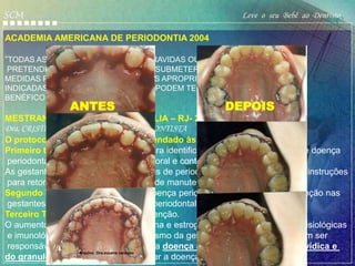 SCM                                                      Leve o seu Bebê ao Dentista
                                                                                S/C
ACADEMIA AMERICANA DE PERIODONTIA 2004

“TODAS AS MULHERES QUE FICAM GRAVIDAS OU QUE
 PRETENDEM ENGRAVIDAR DEVEM SE SUBMETER AO EXAME BUCAL.
MEDIDAS PREVENTIVAS TERAPÊUTICAS APROPRIADAS, SE
INDICADAS,DEVEM SER EFETUADAS E PODEM TER UM EFEITO
BENÉFICO PARA O BEBÊ.”
               ANTES                                 DEPOIS
MESTRANDA EM SAÚDE DA FAMILIA – RJ- 2008
Dra. CRISTIANE PINGARILHO –PERIODONTISTA
O protocolo de atendimento recomendado às pacientes gestantes é:
Primeiro trimestre : Exame clínico para identificação da presença ou não de doença
 periodontal. Instruções sobre higiene oral e controle de placa bacteriana.
As gestantes que não forem portadoras de periodontopatias, devem receber instruções
 para retornarem apenas para terapia de manutenção.
Segundo Trimestre: tratamento da doença periodontal e terapia de manutenção nas
 gestantes que não possuem doença periodontal.
Terceiro Trimestre: terapia de manutenção.
O aumento dos hormônios progesterona e estrogênio acarretam mudanças fisiológicas
 e imunológicas importantes no organismo da gestante. Tais condições podem ser
 responsáveis pelo desenvolvimento da doença periodontal, gengivite gravídica e
                    Arquivo Dra.suzana cardoso
do granuloma piogênico, se já houver a doença pré-existente.
 