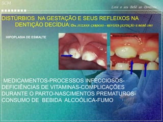 SCM
                                                   Leve o seu Bebê ao Dentista

DISTÚRBIOS NA GESTAÇÃO E SEUS REFLEIXOS NA
    DENTIÇÃO DECÍDUA:Dra. SUZANA CARDOSO – REVISTA GESTAÇÃO E BEBÊ-1995
                                                    Arquivo Dra.suzana cardoso
 HIPOPLASIA DE ESMALTE




MEDICAMENTOS-PROCESSOS INFECCIOSOS-
DEFICIÊNCIAS DE VITAMINAS-COMPLICAÇÕES
DURANTE O PARTO-NASCIMENTOS PREMATUROS-
CONSUMO DE BEBIDA ALCOÓLICA-FUMO
 