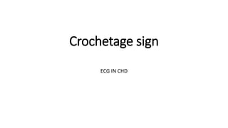 Crochetage sign
ECG IN CHD
 