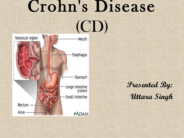 Crohn S Disease