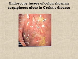 Endoscopy image of colon showing
serpiginous ulcer in Crohn's disease
 