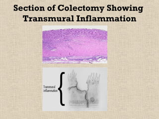 Section of Colectomy Showing
  Transmural Inflammation
 