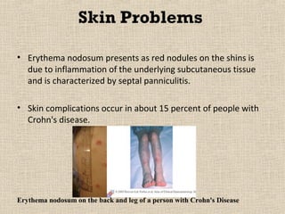 Skin Problems

• Erythema nodosum presents as red nodules on the shins is
  due to inflammation of the underlying subcutaneous tissue
  and is characterized by septal panniculitis.

• Skin complications occur in about 15 percent of people with
  Crohn's disease.




Erythema nodosum on the back and leg of a person with Crohn's Disease
 
