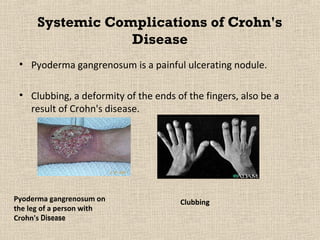 Systemic Complications of Crohn's
                  Disease
 • Pyoderma gangrenosum is a painful ulcerating nodule.

 • Clubbing, a deformity of the ends of the fingers, also be a
   result of Crohn's disease.




Pyoderma gangrenosum on               Clubbing
the leg of a person with
Crohn's Disease
 